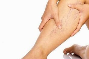 Le ragioni dello sviluppo delle vene varicose sulle gambe