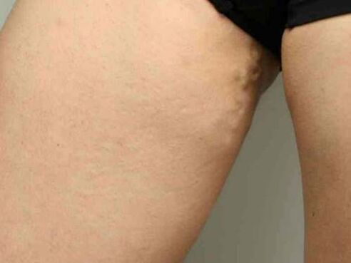 vene varicose del bacino durante la gravidanza